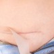 ¿Las Cirugías Estéticas Dejan Cicatrices? Consejos para Reducirlas