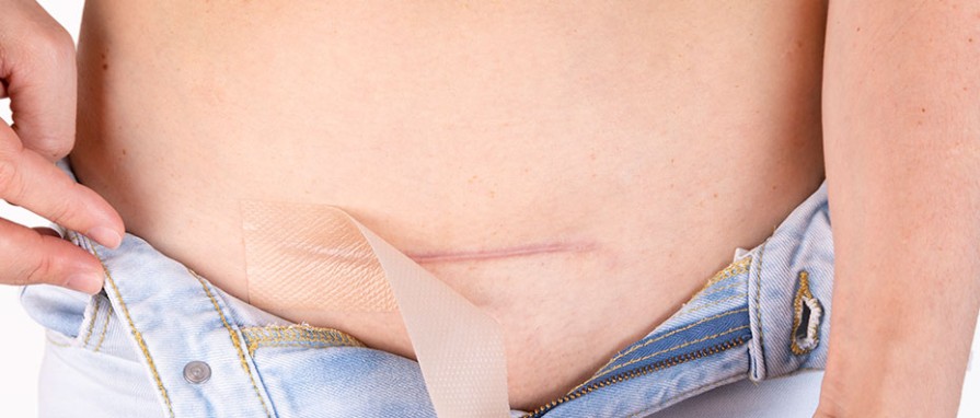 Do Cosmetic Surgeries Leave Scars? Tips to Minimize Scarring