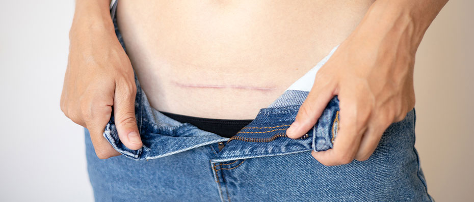 Important Tips for Reducing Scars After Cosmetic Surgery