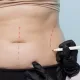 Técnicas de Abdominoplastia y sus Resultados