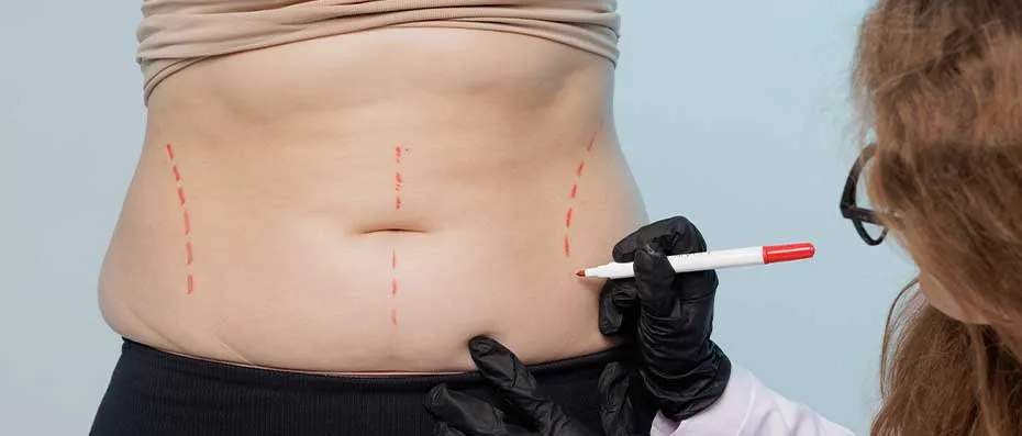 Técnicas de Abdominoplastia y sus Resultados