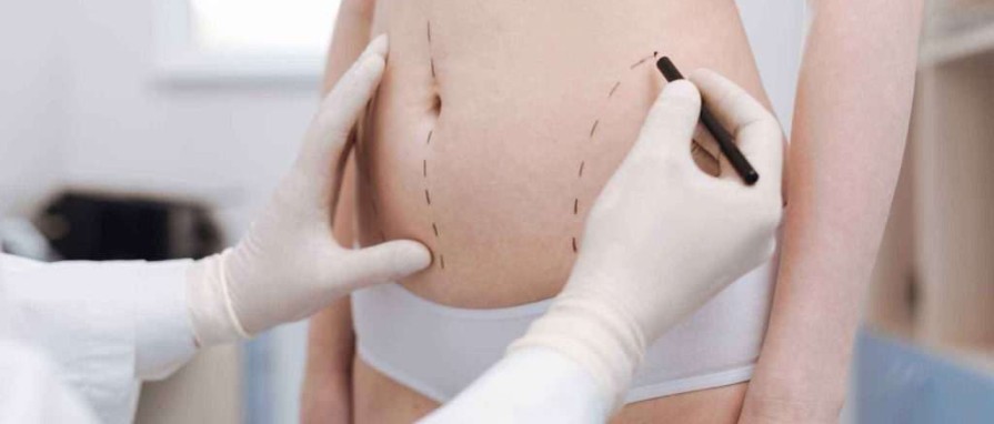 Liposuction: Say Goodbyeto Unwanted Fat