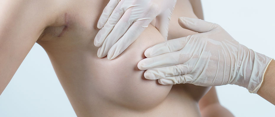 Breast Augmentation with Fat Transfer: Procedure and Results