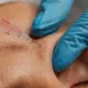 Is Natural Facial Rejuvenation Possible with Fat Injection?